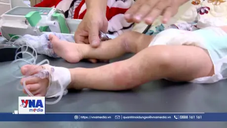 Ghi nhận ca tử vong do bệnh sởi ở Đồng Nai