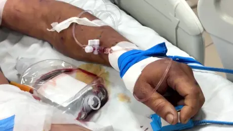 Người đàn ông nguy kịch sau 3 ngày ăn tiết canh