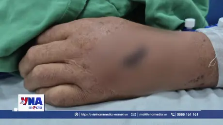 Cấp cứu thành công bệnh nhân ngưng tuần hoàn do điện giật