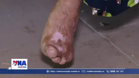 Đến với những bệnh nhân phong ở Hà Nội