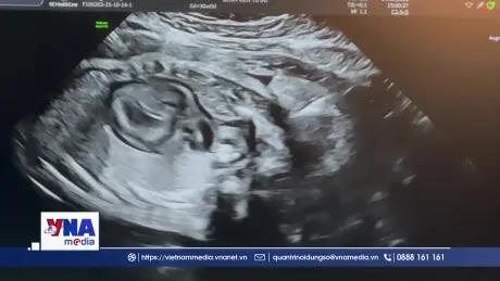 Hai bệnh viện phối hợp thực hiện thành công ca thông tim can thiệp bào thai