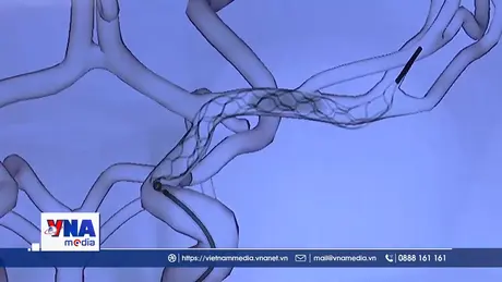 Đột phá phẫu thuật đột quỵ từ xa bằng robot