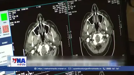Vaccine ngừa zona có thể làm chậm tiến triển của chứng mất trí nhớ
