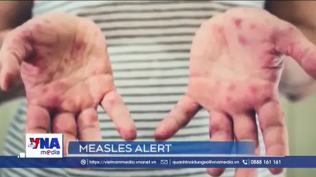 Cảnh báo nguy cơ bệnh sởi lan rộng tại châu Mỹ