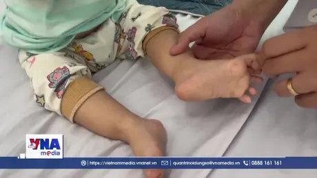 Cảnh báo gia tăng bệnh tay chân miệng ở trẻ nhỏ tại Khánh Hòa