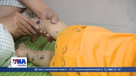 Ninh Bình gia tăng bệnh nhân tay chân miệng ở trẻ nhỏ