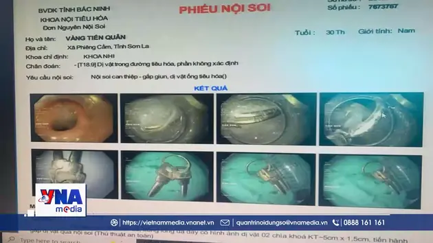 Nội soi gắp chùm chìa khóa trong dạ dày bệnh nhi 30 tháng tuổi