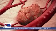 Israel thử nghiệm điều trị u não ác tính tái phát bằng bức xạ alpha