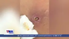 Ca bệnh giun rồng thứ 44 được ghi nhận tại Việt Nam