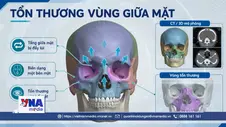 Định vị từng milimet, tái tạo khuôn mặt biến dạng