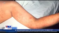 Mỹ ghi nhận những ca tử vong đầu tiên do bệnh sởi