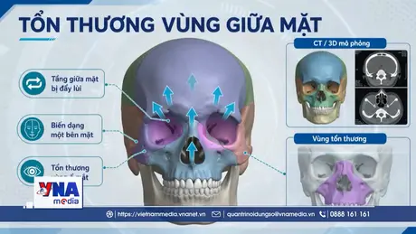 Định vị từng milimet, tái tạo khuôn mặt biến dạng