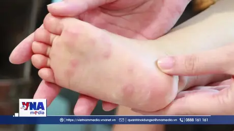 Gần 100.000 ca tay chân miệng, tăng cường phòng dịch tại trường học