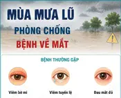 Phòng chống bệnh về mắt trong mùa mưa lũ
