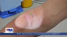 Bệnh viêm da do kiến ba khoang tăng, cảnh báo nguy cơ biến chứng